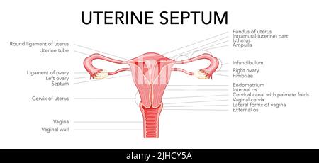 Uterine Septum septate uterus Weibliche Darstellung des Fortpflanzungssystems mit Beschriftungen Text. Vorderansicht im Schnitt. Menschliche Anatomie innere Organe flache Stil Symbol Vektor medizinische Illustration isoliert Stock Vektor