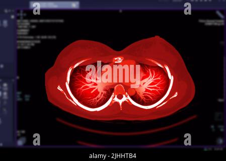 CT-Thorax- oder CT-Scan der Lungen-Axial- und Koronalansicht. Stockfoto