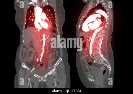 CTA Whole Aorta zeigt das Bild der Arterien im ganzen Körper und vergleicht die koronale und sagittale Ansicht, die vom CT-Scanner erzeugt wurde Stockfoto