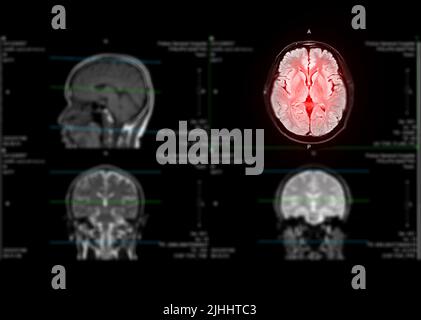MRT-Gehirn axiales Gespür für die Erkennung von Schlaganfallerkrankungen und Hirntumoren und Zysten. Stockfoto