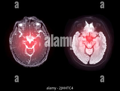 MRT-axiales Diffusionsbild des Gehirns zur Erkennung von Schlaganfallerkrankungen und Hirntumoren und Zysten. Stockfoto