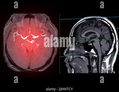 MRA Gehirn oder Magnetresonanzangiographie des Gehirns axiale MIP-Ansicht zeigt Hirnarterie . Stockfoto