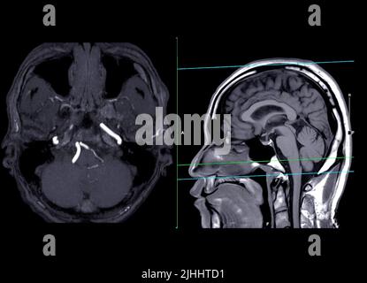 MRA Gehirn- oder Magnetresonanzangiographie der axialen MIP und sagittalen Ansicht des Gehirns, die die Hirnarterie zeigt. Stockfoto