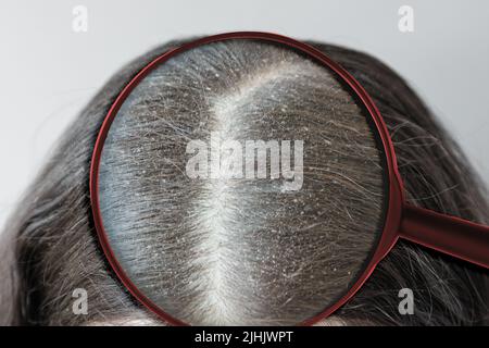 Nahaufnahme des Scheitelens von brünetten Haaren auf dem Kopf, bedeckt mit Schuppen. Blick durch vergrößertes Glas. Das Konzept der seborrhoischen Dermatitis. Stockfoto