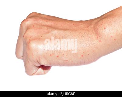 Mehrere juckende Moskitos oder Insektenbiss-Keuchen; rote Flecken auf der Hand des südostasiatischen, chinesischen erwachsenen jungen Mannes. Isoliert auf weißem Hintergrund. Stockfoto