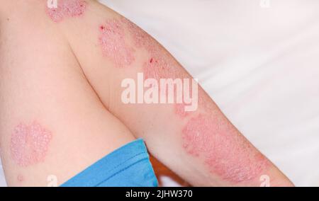 Großer rot entflammter schuppiger Ausschlag an den Händen. Akute Psoriasis am Arm eines Mannes, starke Rötung auf der Haut, eine Autoimmunerkrankung, die nicht heilbar dermatologisch ist Stockfoto
