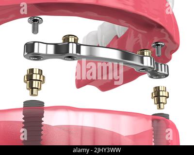 3D Render of bar retried removable overdenture Installation unterstützt durch zwei Implantate Stockfoto