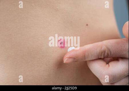 Eine Frau schmiert eine Wunde mit Creme, nachdem sie eine Warze verbrannt hat. Stockfoto