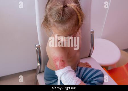 Kleinkind mit verbrannter Wunde am Arm, Kinderunfällen, Verbrennungen und Verbrühungen bei Kindern Stockfoto