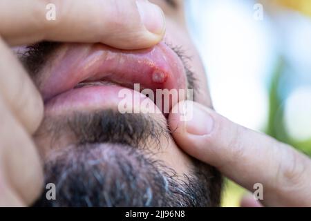 Nahaufnahme der Stomatitis in den Mund. Ein Mann hat ein aphtöses Geschwulst oder einen Mundgerippe an der Lippe Stockfoto