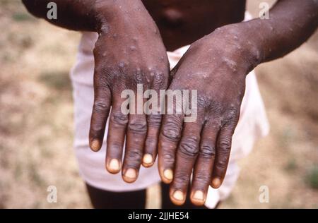 Ein Mann, der mit Monkeypox infiziert ist, zeigt seine Hände mit den charakteristischen Hautausschlägen und Blasen während der Genesungsphase der Viruserkrankung, die im Februar 1997 in der Katako-Kombe Health Zone, Kasai Oriental, Demokratische Republik Kongo, aufgenommen wurde. Stockfoto