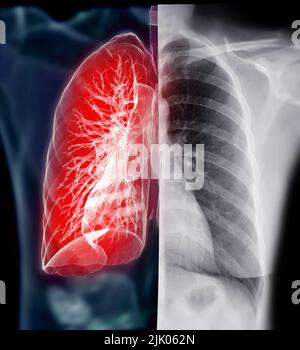 Röntgenaufnahme des Brustkorbs mit Lung 3D-Rendering zur Diagnose TB, Tuberkulose und Covid-19. Medizinisches Bildgebungskonzept. Stockfoto