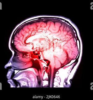 MRA Gehirn- oder Magnetresonanzangiographie der Hirnarterie in der sagittalen Ansicht des Gehirns zur Bewertung der Stenose und Schlaganfallerkrankungen. Stockfoto