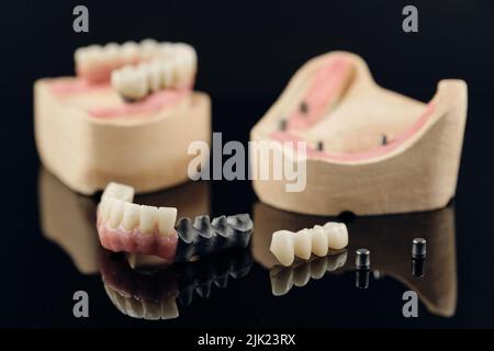 Zusammensetzung von Zahnkronen und orthopädischen Komponenten auf schwarzem Hintergrund. Vollständige Anatomie Aus Zirkonia Stockfoto