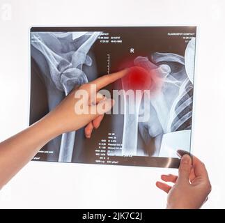 Zeigefinger, der auf ein Trauma am Arm zeigt, Röntgenbild mit rotem Punkt. Akromion, akromiale Endfraktur. Arzt, der eine Schulter-, Schlüsselbein-Verletzung zeigt. Gebrochenes Schlüsselbein, Übernutzung, Verrenkung. Hochwertige Fotos Stockfoto