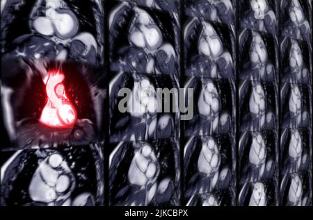 MRT Herz- oder Herz-MRT (Magnetresonanztomographie) des Herzens in koronaler Ansicht, die die SA-Ebene des Herzens zum Nachweis von Herzerkrankungen zeigt. Stockfoto