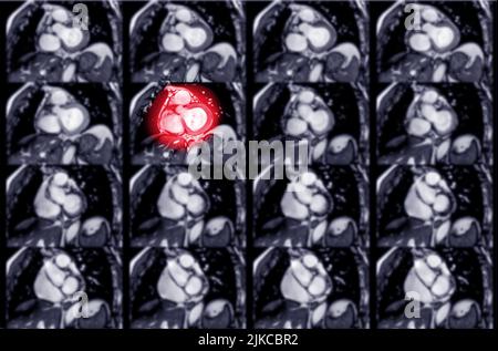 MRT Herz- oder Herz-MRT (Magnetresonanztomographie) des Herzens in koronaler Ansicht, die die SA-Ebene des Herzens zum Nachweis von Herzerkrankungen zeigt. Stockfoto