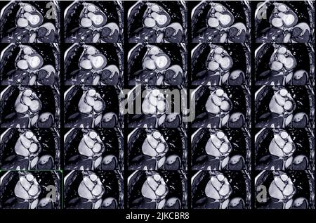 MRT Herz- oder Herz-MRT (Magnetresonanztomographie) des Herzens in koronaler Ansicht, die die SA-Ebene des Herzens zum Nachweis von Herzerkrankungen zeigt. Stockfoto