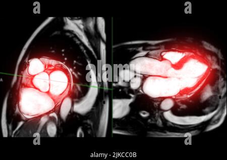 MRT Herz- oder Herz-MRT (Magnetresonanztomographie) des Herzens in kurzer und vertikaler Längsachse-Ansicht, in der das Herz die SA-Ebene für Detektin schlägt Stockfoto