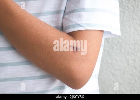 Heilende Wunde an der Kinderhand. Tiefe Kratzer auf der Ellbogenhaut des Teenagers. Wunden, Kratzer, verkrusteter Abrieb, Narbe, Behandlung von Verletzungen, Medizinisch Stockfoto