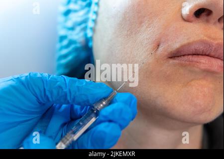 Nahaufnahme einer Spritze in einer verschönerenden Behandlung, bei der Hyaluronsäure auf eine Person neben den Lippen aufgetragen wird Stockfoto