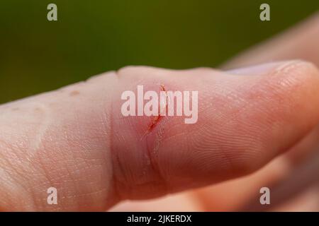 Ein abgeschnittener Daumen an der Hand, ein heilender Schnitt am Finger eines Mannes Stockfoto