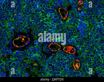 Immunfluoreszierende Färbung des Merkelzellkarzinom-Tumorgewebes, die die Expression von CD200 (grün) auf der Oberfläche von Tumorzellen veranschaulicht. CD200 spielt eine Rolle bei der Immunsuppression. Der Endothelmarker CD31 (rot) markiert die Blutgefäße. Das Merkel-Zellkarzinom ist ein seltener und aggressiver Hautkrebs. Stockfoto