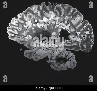 Dies ist ein pseudo-farbiger Bildausschnitt eines hochauflösenden Gradientenecho-MRT einer festen Gehirnhemisphäre einer Person mit multipler Sklerose. Stockfoto