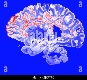 Dies ist ein pseudo-farbiger Bildausschnitt eines hochauflösenden Gradientenecho-MRT einer festen Gehirnhemisphäre einer Person mit multipler Sklerose. Stockfoto