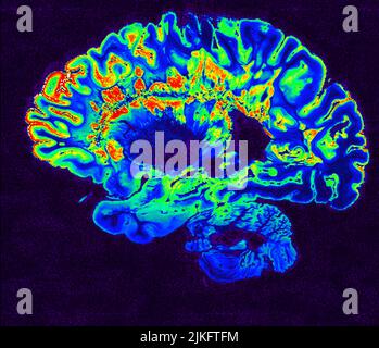 Dies ist ein pseudo-farbiger Bildausschnitt eines hochauflösenden Gradientenecho-MRT einer festen Gehirnhemisphäre einer Person mit multipler Sklerose. Stockfoto