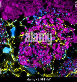 Geruchsempfindliche Neuronen bilden lange Verbindungen (rosa), die durch die Nasengänge in das Gehirn gelangen, wo sie mit anderen Neuronen (blau und gelb) interagieren. Im Laufe des Lebens sterben diese Neuronen ab und werden durch neue ersetzt. Forscher versuchen herauszufinden, wie und wann dies bei Mäusen geschieht. Stockfoto