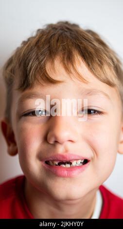 Porträt eines Jungen mit schlechten Zähnen, gefallenen vorderen oberen Zähnen Stockfoto