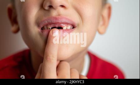 Porträt eines Jungen mit schlechten Zähnen, gefallenen vorderen oberen Zähnen Stockfoto