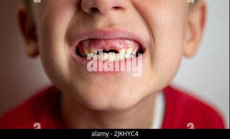 Porträt eines Jungen mit schlechten Zähnen, gefallenen vorderen oberen Zähnen Stockfoto