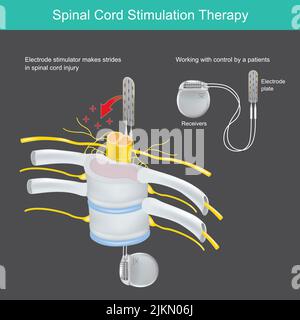 Therapie Der Rückenmarksstimulation. Ein elektronisches Implantat für den Körpereinsatz zur Hals- und Rückenschmerztherapie. Stock Vektor