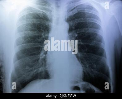 Eine Röntgenaufnahme des Brustkorbs einer Person in Nahaufnahme Stockfoto