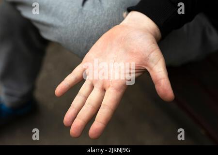 Handfläche mit Narbe. Hand des Mannes mit Schnitt. Narbe auf der Haut. Große Handfläche. Stockfoto