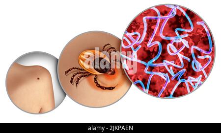 Lyme-Borreliose und Hirsch Zecke kriechen auf der Haut als bakterielle Infektion Gesundheitsgefahr als der Biss eines Parasiten verursacht eine Krankheit mit Bakterien. Stockfoto