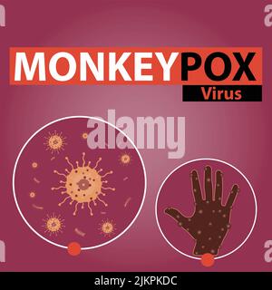 Ein Vektor-Illustration Banner-Design für das Monkeypox-Virus. Virale Zoonose. Illustration der Hand mit juckenden Ausschlag. Stock Vektor