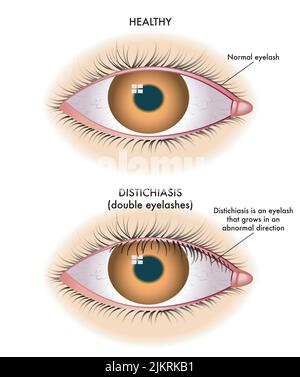 Die medizinische Illustration zeigt den Vergleich zwischen einem normalen Auge und einem von der Destichiasis betroffenen Auge. Stock Vektor