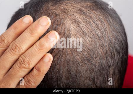 Kahlheit, Haarausfall, Schuppen am Kopf, sichtbare Kopfhaut. Mann, der sein dünnes Haar oder seinen Alopezie-Kopf berührt. Stockfoto