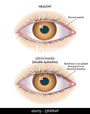 Die medizinische Illustration zeigt den Vergleich zwischen einem normalen Auge und einem von der Destichiasis betroffenen Auge. Stockfoto