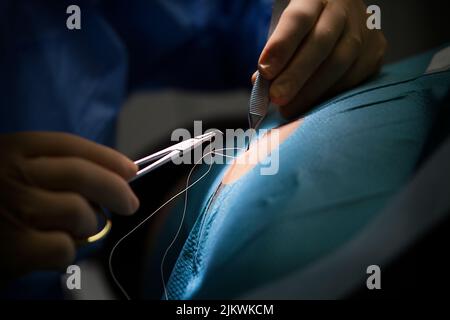 Stiche nach Entfernung einer Zyste durch den Dermatologen. Stockfoto