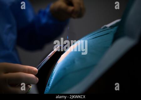 Stiche nach Entfernung einer Zyste durch den Dermatologen. Stockfoto