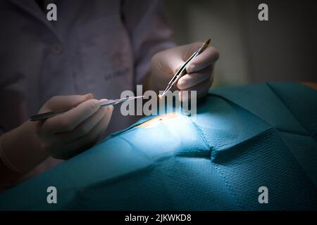 Der Dermatologe entfernt einen verdächtigen Maulwurf. Stockfoto