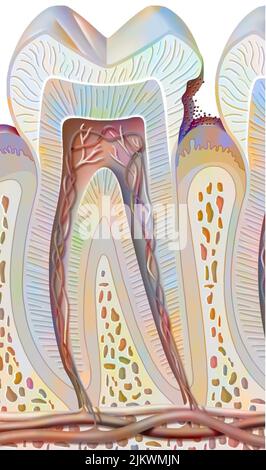 Zahnkaries im ersten Stadium (Zahnschmelzschäden). Stockfoto