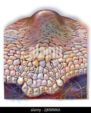 Gewöhnliche Warze: Gutartiger epithelialer Hauttumor, der durch Papillomaviren verursacht wird. Stockfoto