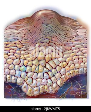 Gewöhnliche Warze: Gutartiger epithelialer Hauttumor, der durch Papillomaviren verursacht wird. Stockfoto