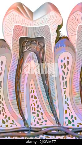 Zahnkaries im ersten Stadium (Zahnschmelzschäden). Stockfoto