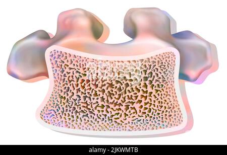 Aufbau eines gesunden dorsalen Wirbels mit schwammigem und kompaktem Gewebe. Stockfoto